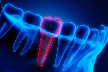 Dental Implant And Prosthetics