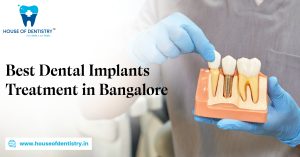Best Dental Implants Treatment in Bangalore