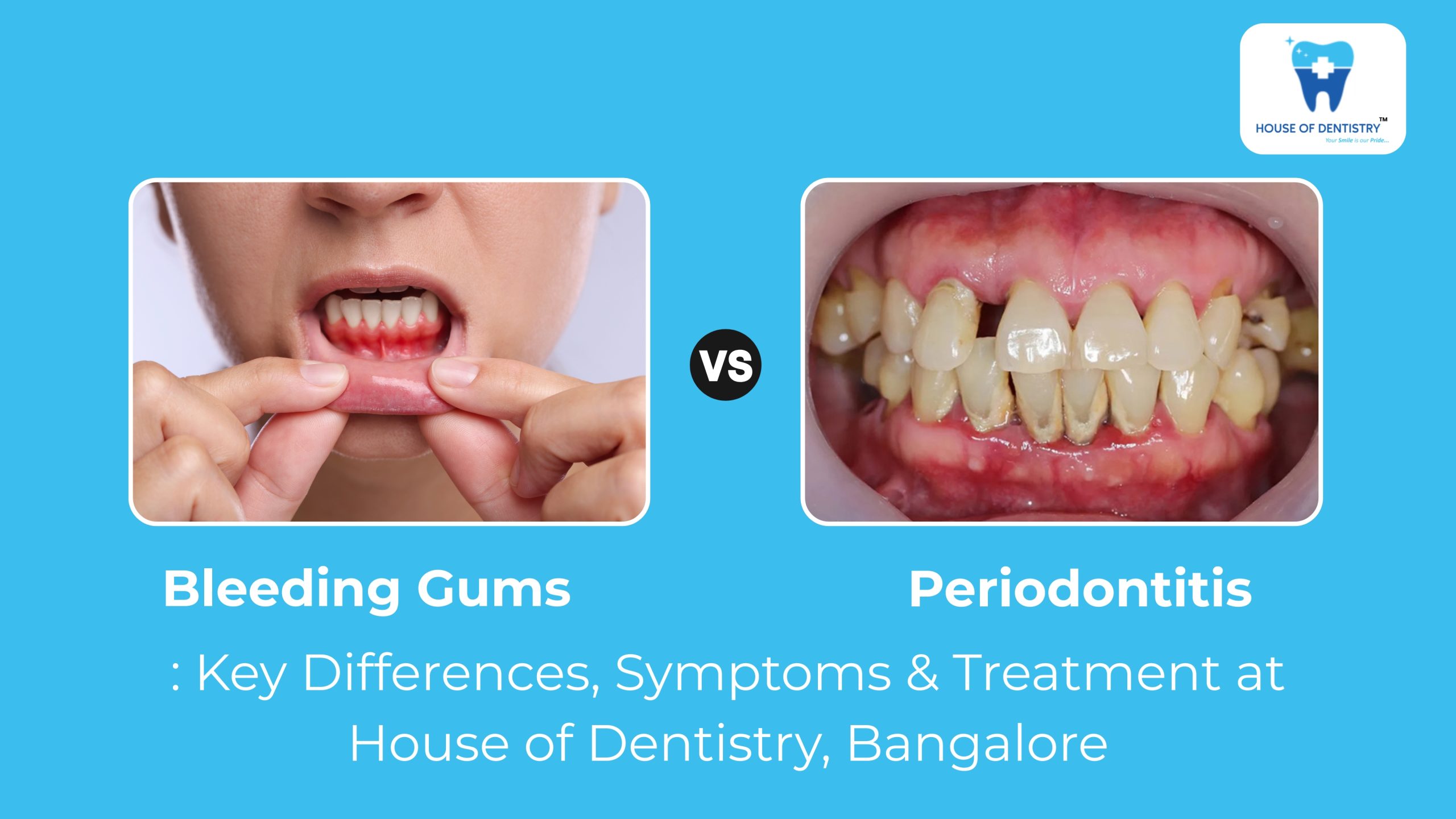 Bleeding Gums vs Periodontitis: Key Differences, Symptoms & Treatment at House of Dentistry, Bangalore