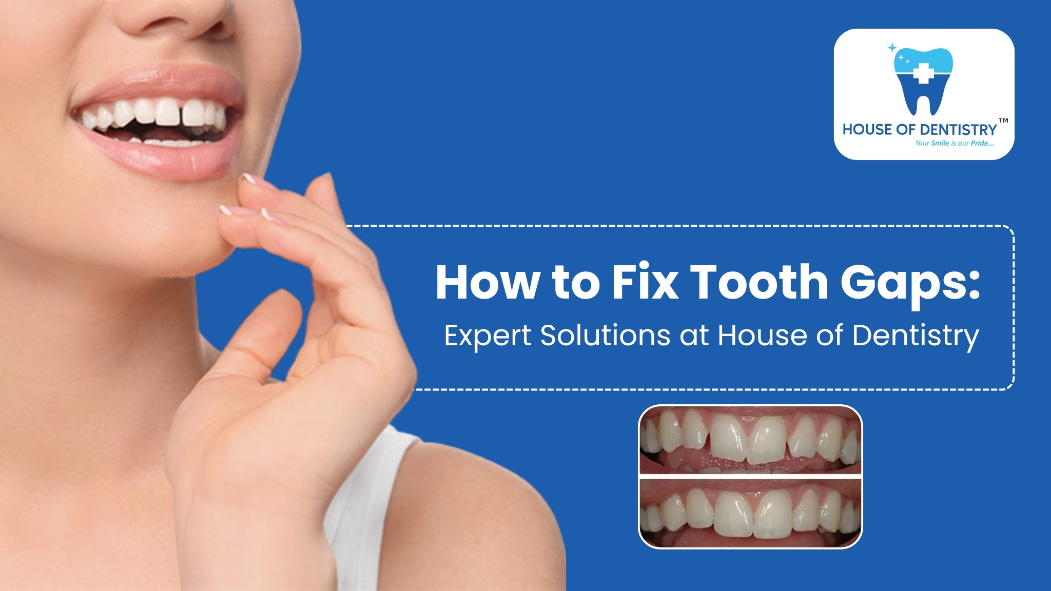 How to Fix Tooth Gaps: Expert Solutions at House of Dentistry